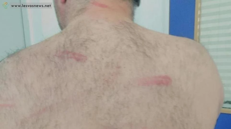 Άγριο ξύλο σε κοπή πίτας σε καφενείο της Λέσβου – Τι κατήγγειλε ο άνδρας που ξυλοκοπήθηκε